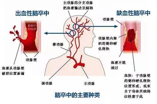 肺炎-呼吸訓(xùn)練器-基層肺功能-腦卒中-心血管病-中風(fēng)-腦梗-慢阻肺-哮喘-呼吸肌-排痰-肺功能檢測儀-賽客