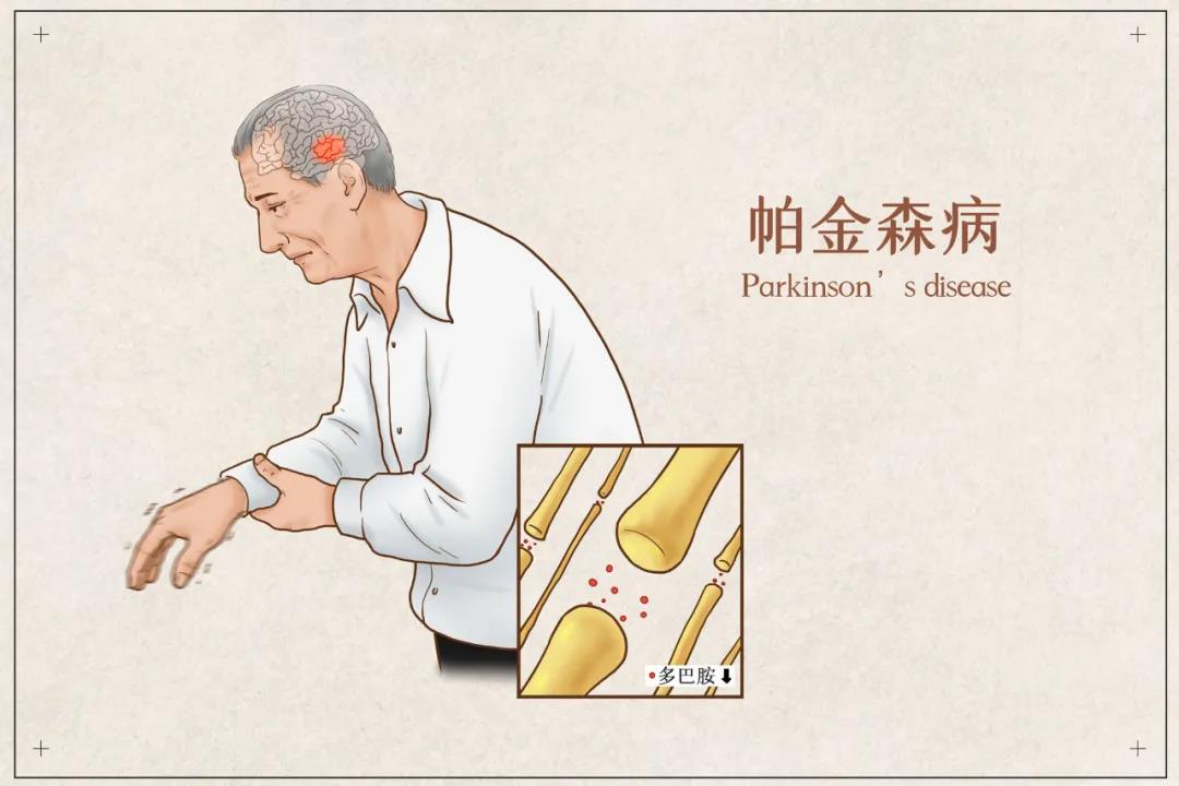 帕金森-肺炎-肺部感染-呼吸-康復(fù)-呼吸訓(xùn)練-呼吸操-呼吸訓(xùn)練器-呼氣檢測-吸氣檢測-肺功能檢查-肺功能檢測儀-肺康復(fù)-輔助呼吸訓(xùn)練-震顫-手抖-肌強直-呼吸抗阻訓(xùn)練 